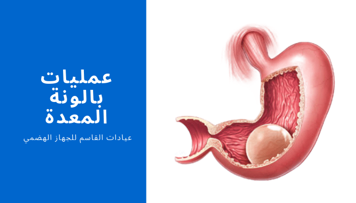 عمليات بالونة المعدة